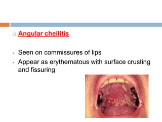 PATHOLOGY AND MANAGEMENT OF PERIODONTAL PROBLEMS IN PATIENTS WITH HIV ...