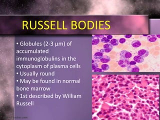 • Globules (2-3 μm) of
accumulated
immunoglobulins in the
cytoplasm of plasma cells
• Usually round
• May be found in normal
bone marrow
• 1st described by William
Russell
RUSSELL BODIES
 