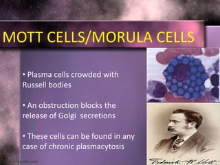 MOTT CELLS/MORULA CELLS
• Plasma cells crowded with
Russell bodies
• An obstruction blocks the
release of Golgi secretions
• These cells can be found in any
case of chronic plasmacytosis
 