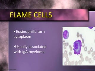 FLAME CELLS
• Eosinophilic torn
cytoplasm
•Usually associated
with IgA myeloma
 