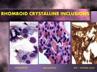 RHOMBOID CRYSTALLINE INCLUSIONS
intracellular extracellular IHC – lambda chain
 