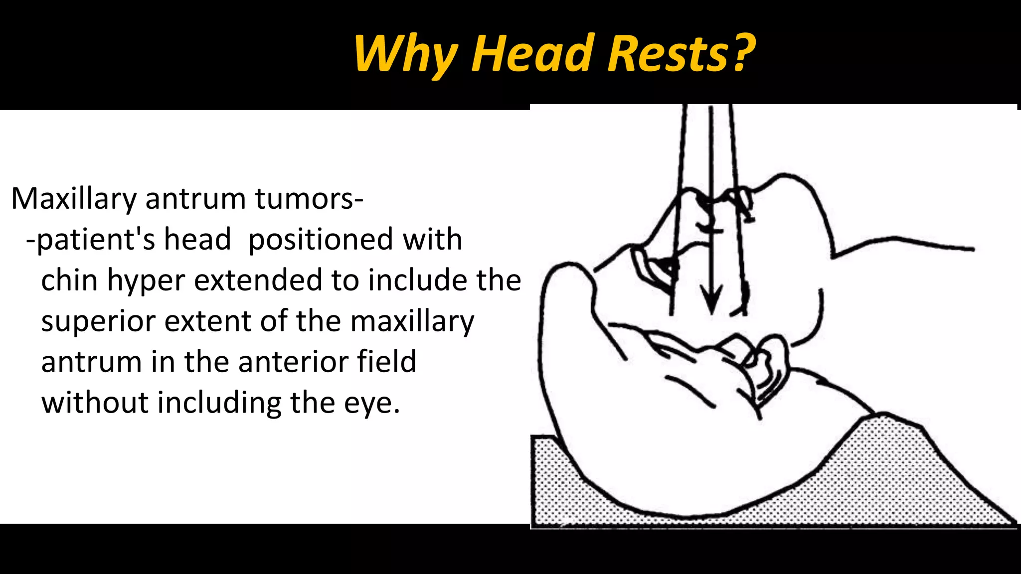 Why Head Rests? 
Maxillary antrum tumors- 
-patient's head positioned with 
chin hyper extended to include the 
superior extent of the maxillary 
antrum in the anterior field 
without including the eye. 
 