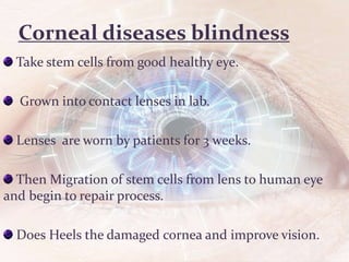 Corneal diseases blindness
Take stem cells from good healthy eye.
Grown into contact lenses in lab.
Lenses are worn by patients for 3 weeks.
Then Migration of stem cells from lens to human eye
and begin to repair process.
Does Heels the damaged cornea and improve vision.
 