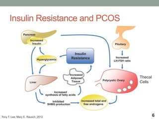 Insulin Resistance and PCOS
6Tony T. Lee; Mary E. Rausch, 2012
Thecal
Cells
 
