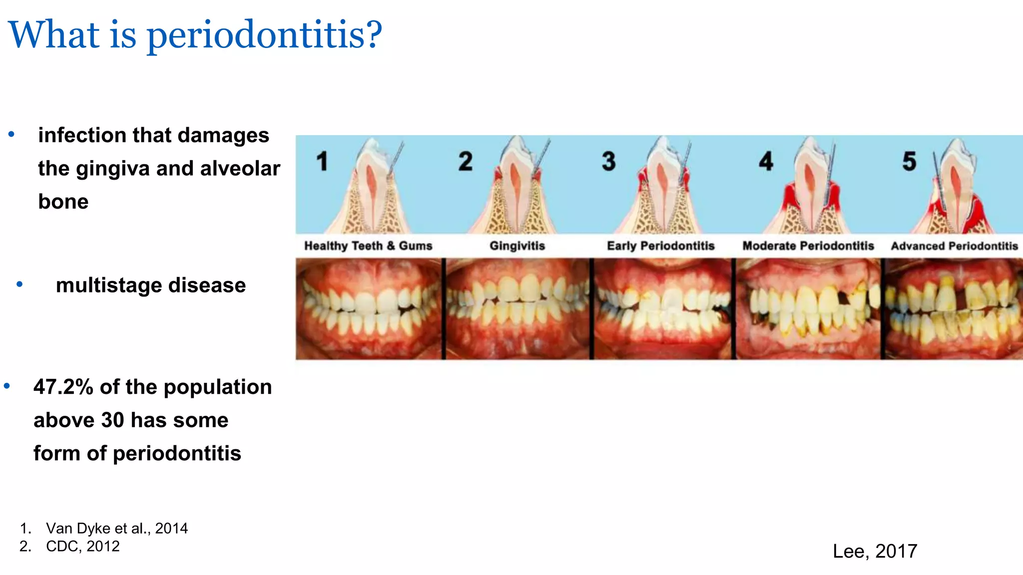 Diabetes Impact on Periodontitis | PPT