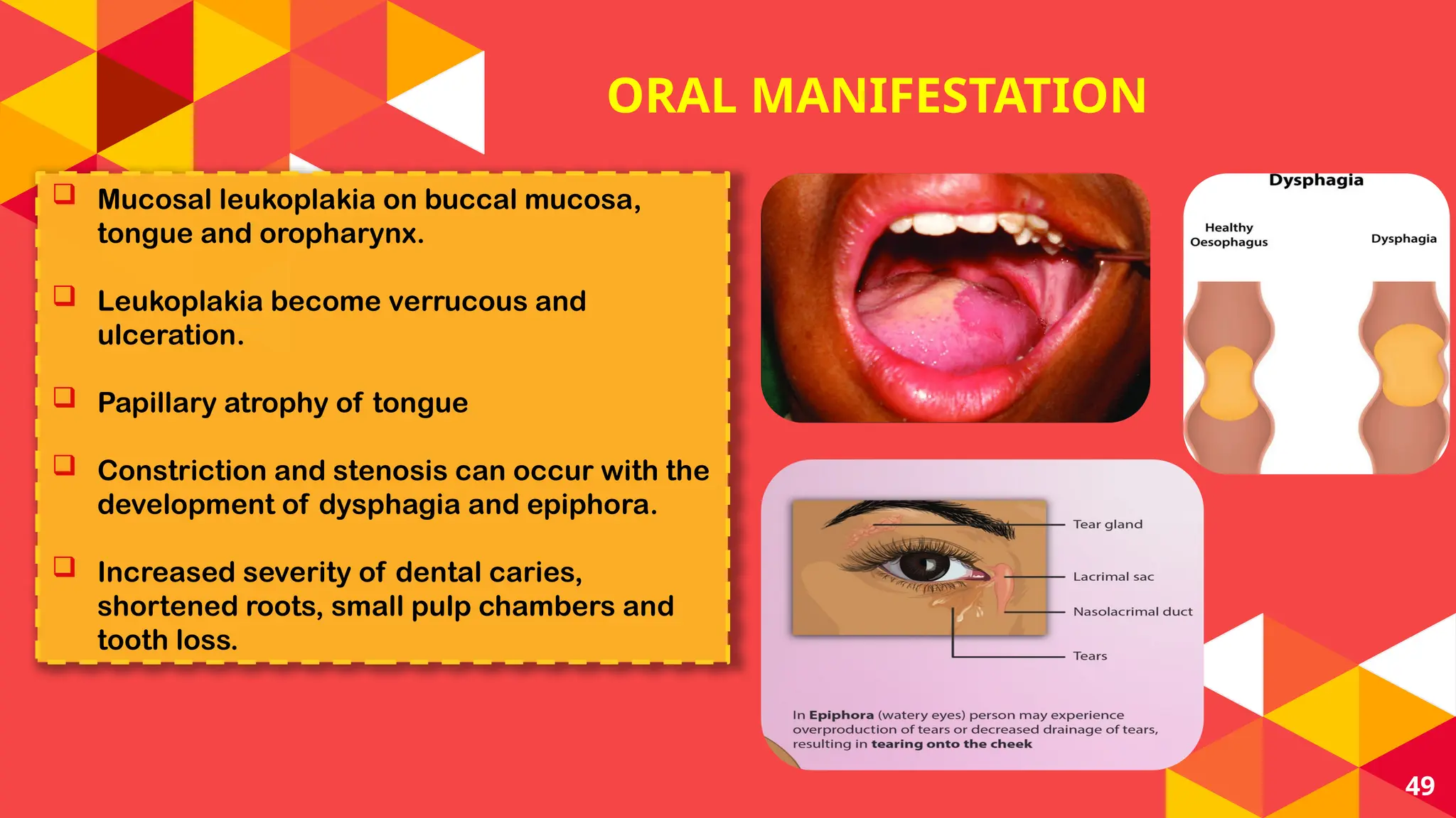 ORAL POTENTIALLY MALIGNANT DISORDERS (OPMD) | PPT