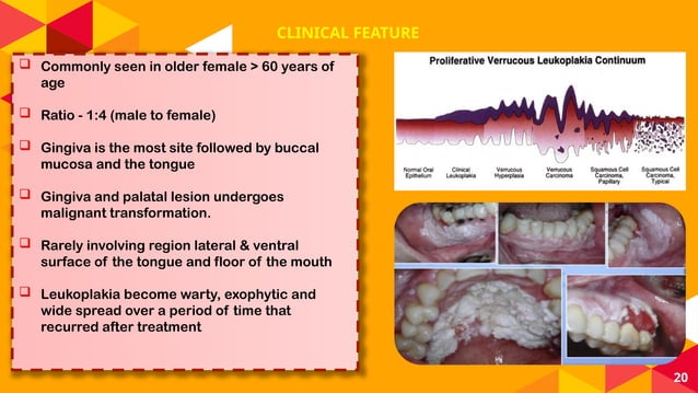 ORAL POTENTIALLY MALIGNANT DISORDERS (OPMD) | PPTX