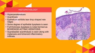 Drop Rete Ridges ORAL POTENTIALLY MALIGNANT DISORDERS (OPMD) | PPTX