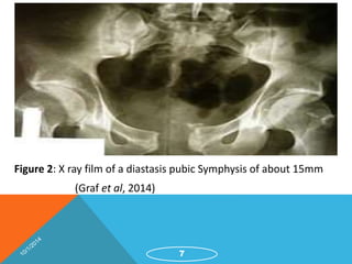 Figure 2: X ray film of a diastasis pubic Symphysis of about 15mm 
(Graf et al, 2014) 
7 
 