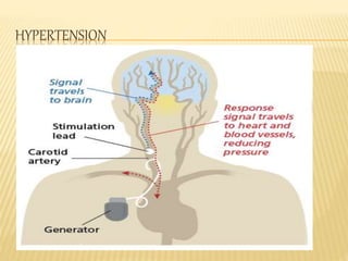 HYPERTENSION
 