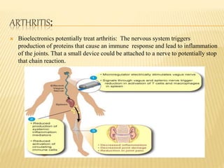 ARTHRITIS:
 Bioelectronics potentially treat arthritis: The nervous system triggers
production of proteins that cause an immune response and lead to inflammation
of the joints. That a small device could be attached to a nerve to potentially stop
that chain reaction.
 