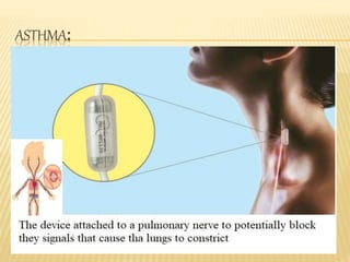 ASTHMA:
 
