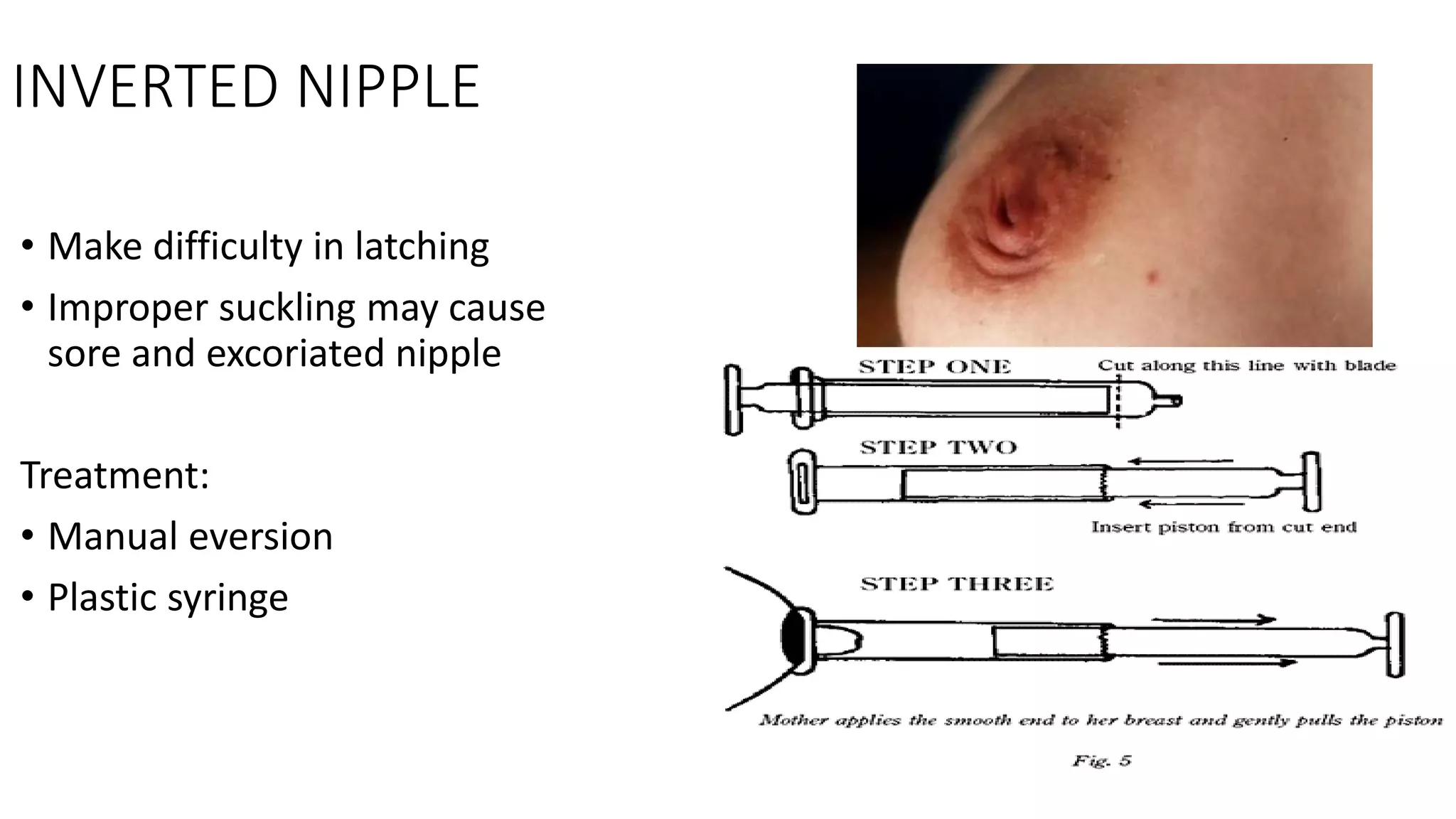 INVERTED NIPPLE
• Make difficulty in latching
• Improper suckling may cause
sore and excoriated nipple
Treatment:
• Manual eversion
• Plastic syringe