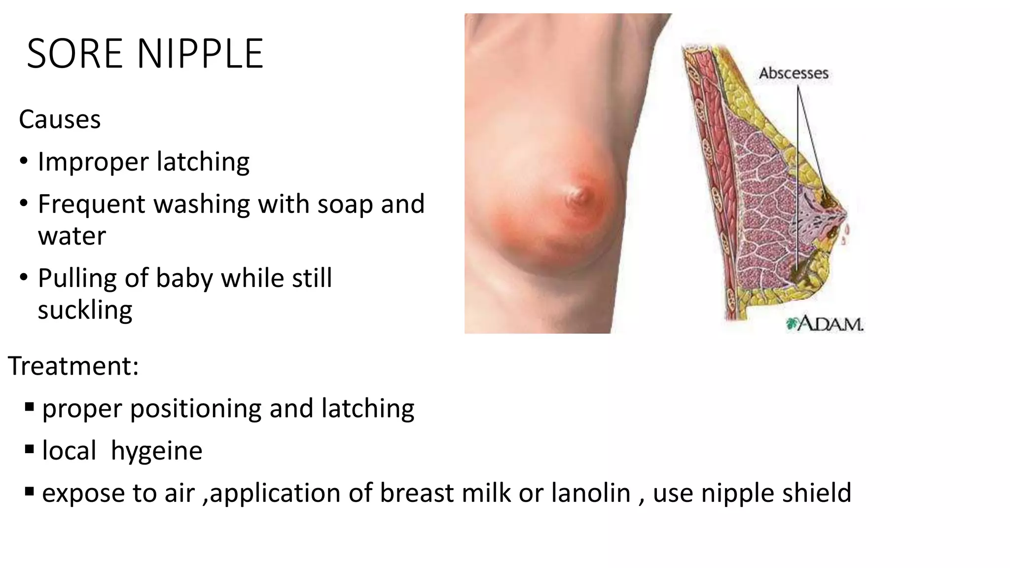 SORE NIPPLE
Causes
• Improper latching
• Frequent washing with soap and
water
• Pulling of baby while still
suckling
Treatment:
proper positioning and latching
local hygeine
expose to air ,application of breast milk or lanolin , use nipple shield