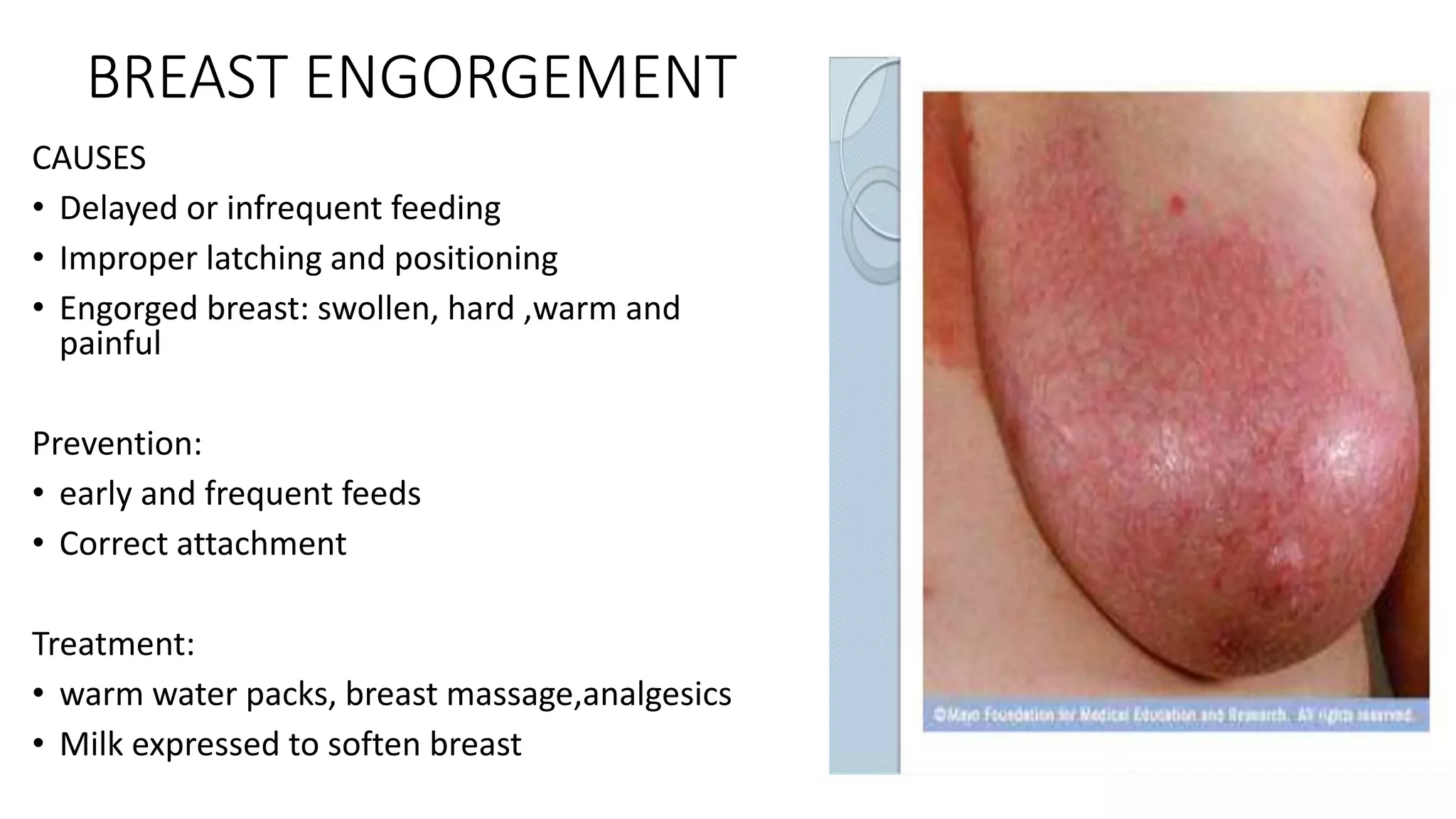 BREAST ENGORGEMENT
CAUSES
• Delayed or infrequent feeding
• Improper latching and positioning
• Engorged breast: swollen, hard ,warm and
painful
Prevention:
• early and frequent feeds
• Correct attachment
Treatment:
• warm water packs, breast massage,analgesics
• Milk expressed to soften breast