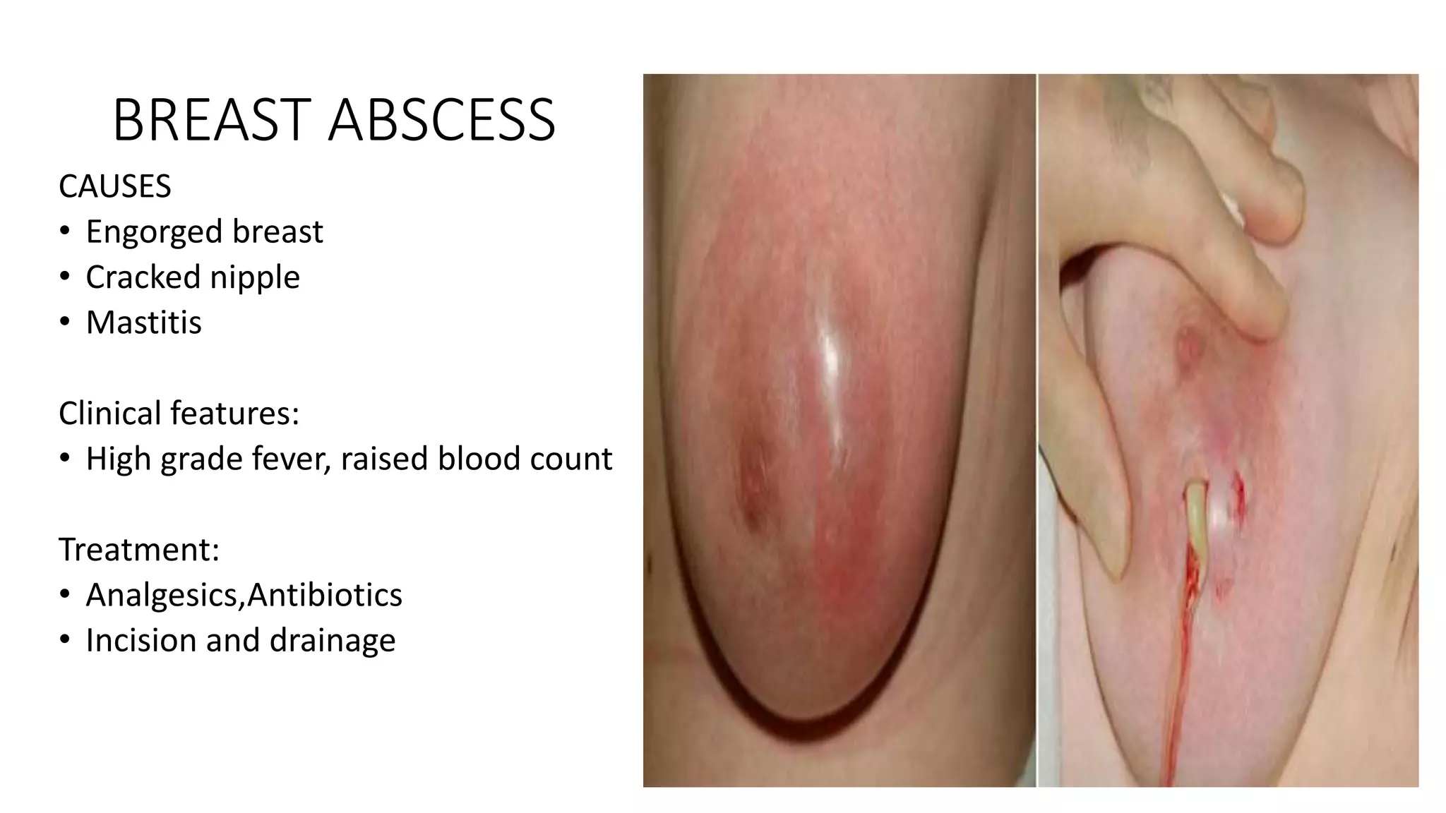 BREAST ABSCESS
CAUSES
• Engorged breast
• Cracked nipple
• Mastitis
Clinical features:
• High grade fever, raised blood count
Treatment:
• Analgesics,Antibiotics
• Incision and drainage