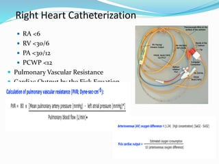 Right Heart Catheterization
 RA <6
 RV <30/6
 PA <30/12
 PCWP <12
 Pulmonary Vascular Resistance
 Cardiac Output by the Fick Equation
 