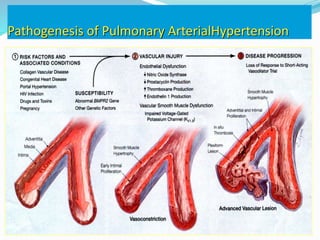 Pathogenesis of Pulmonary ArterialHypertension
 