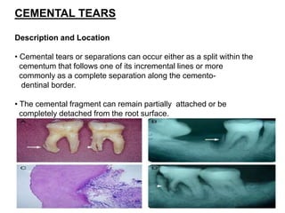 CEMENTAL TEARS
Description and Location
• Cemental tears or separations can occur either as a split within the
cementum that follows one of its incremental lines or more
commonly as a complete separation along the cemento-
dentinal border.
• The cemental fragment can remain partially attached or be
completely detached from the root surface.
 