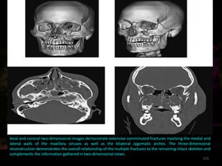 conventional radiography in maxillofacial trauma
