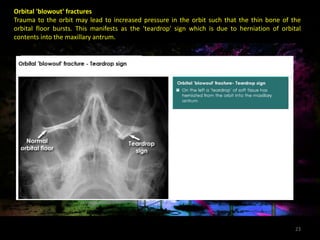 Tear Sign conventional radiography in maxillofacial trauma | PPTX