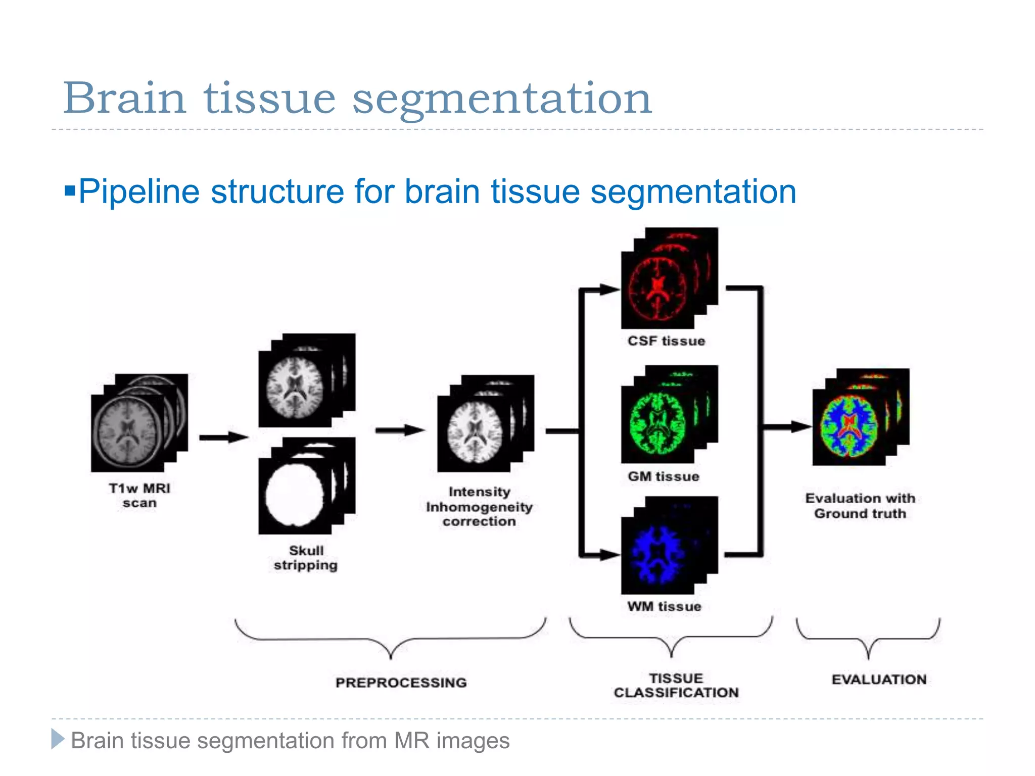 Brain tissue segmentation
Pipeline structure for brain tissue segmentation
Brain tissue segmentation from MR images
 