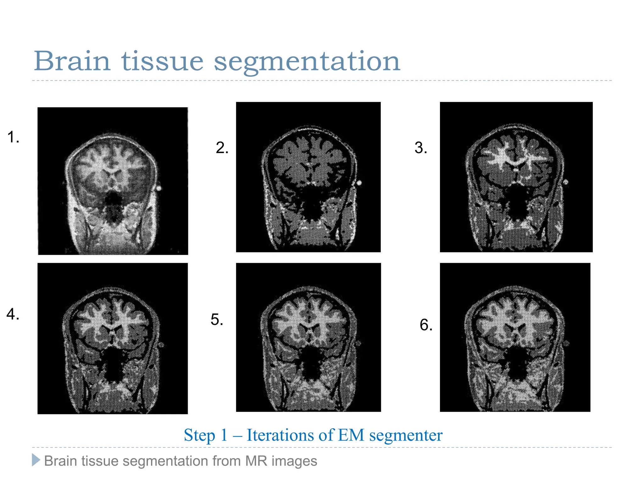 1.
2. 3.
4. 5. 6.
Step 1 – Iterations of EM segmenter
Brain tissue segmentation
Brain tissue segmentation from MR images
 