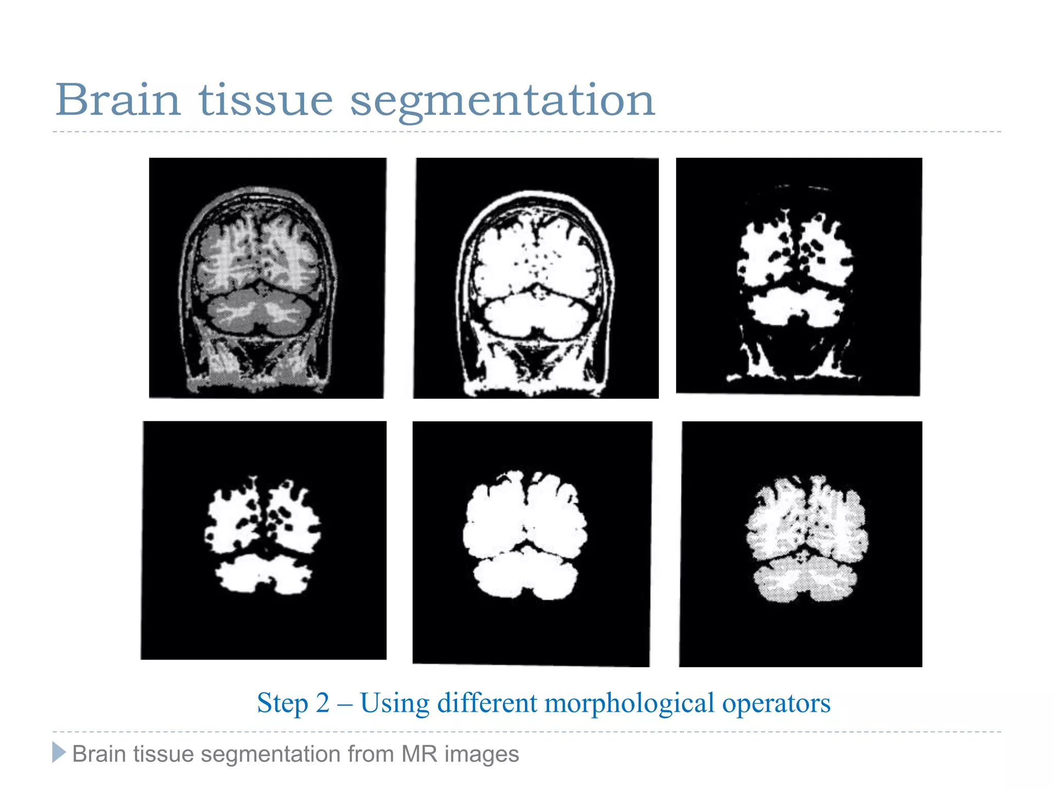 Brain tissue segmentation
Step 2 – Using different morphological operators
Brain tissue segmentation from MR images
 