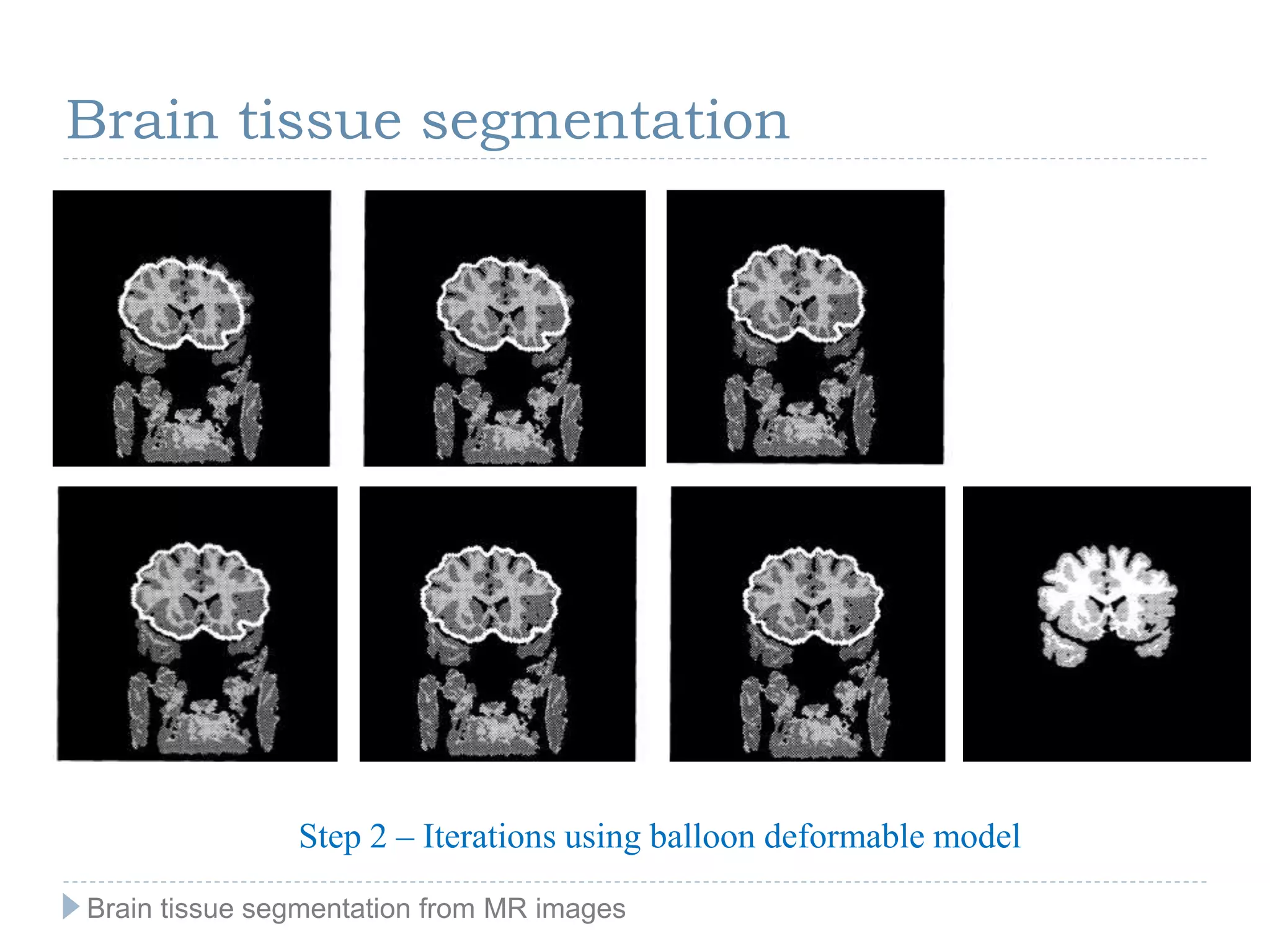 Step 2 – Iterations using balloon deformable model
Brain tissue segmentation
Brain tissue segmentation from MR images
 