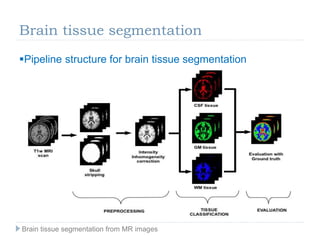 Brain tissue segmentation
Pipeline structure for brain tissue segmentation
Brain tissue segmentation from MR images
 