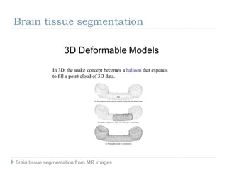 Brain tissue segmentation
Brain tissue segmentation from MR images
 