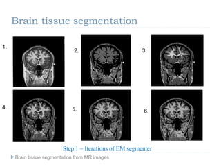 1.
2. 3.
4. 5. 6.
Step 1 – Iterations of EM segmenter
Brain tissue segmentation
Brain tissue segmentation from MR images
 