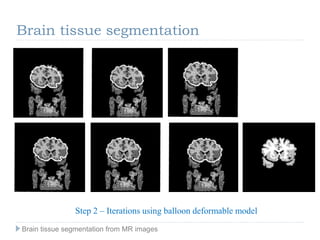 Step 2 – Iterations using balloon deformable model
Brain tissue segmentation
Brain tissue segmentation from MR images
 