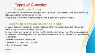 Classical Incision Labour Seminar topic of cesarean section 02pptx | PPTX