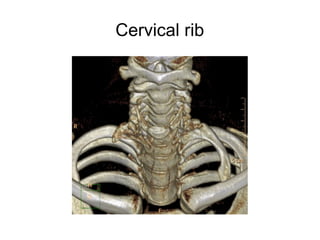 Seminar tos THORACIC OUTLET SYNDROME | PPT