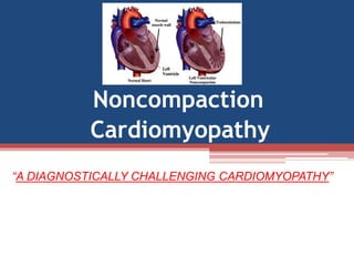 Noncompaction
Cardiomyopathy
“A DIAGNOSTICALLY CHALLENGING CARDIOMYOPATHY”
 