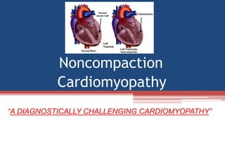 • In patients with myocardial noncompaction, the normal
process of myocardial compaction has undergone a
premature arrest....