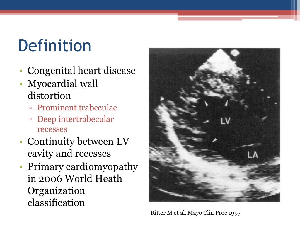 cardiomyopathy