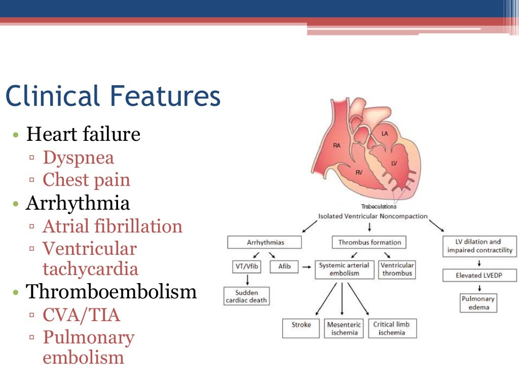 cardiomyopathy