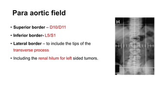 Para aortic field
• Superior border – D10/D11
• Inferior border- L5/S1
• Lateral border – to include the tips of the
transverse process
• Including the renal hilum for left sided tumors.
 