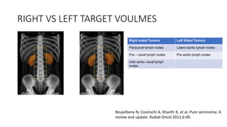 RIGHT VS LEFT TARGET VOULMES
Boujelbene N, Cosinschi A, Khanfir K, et al. Pure seminoma: A
review and update. Radiat Oncol 2011;6:90.
Right sided Tumors Left Sided Tumors
Paracaval lymph nodes Latero-aortic lymph nodes
Pre – caval lymph nodes Pre aortic lymph nodes
Inter aorto- caval lymph
nodes
 