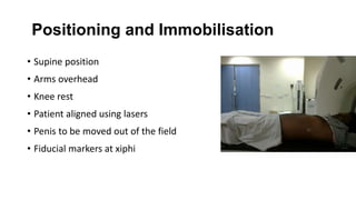 Positioning and Immobilisation
• Supine position
• Arms overhead
• Knee rest
• Patient aligned using lasers
• Penis to be moved out of the field
• Fiducial markers at xiphi
 