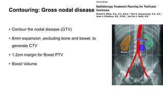 Contouring: Gross nodal disease
• Contour the nodal disease (GTV)
• 8mm expansion ,excluding bone and bowel, to
generate CTV
• 1.2cm margin for Boost PTV
• Boost Volume
 