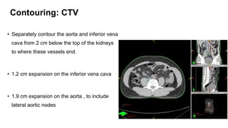 Contouring: CTV
• Separately contour the aorta and inferior vena
cava from 2 cm below the top of the kidneys
to where these vessels end.
• 1.2 cm expansion on the inferior vena cava
• 1.9 cm expansion on the aorta , to include
lateral aortic nodes
 