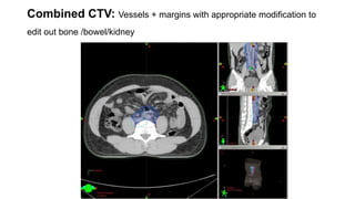 Combined CTV: Vessels + margins with appropriate modification to
edit out bone /bowel/kidney
 