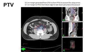 PTV
0.5 cm margin generated from CTV1 to form PTV1 to account for setup errors
0.7 cm margin to PTV1 from block edge to take beam penumbra into account
 
