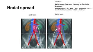 Nodal spread
Left testis Right testis
 