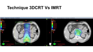 Technique 3DCRT Vs IMRT
 