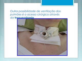Outra possibilidade de ventilação dos
pulmões é o acesso cirúrgico através
da traqueostomia.
 