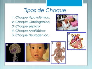 Tipos de Choque
1. Choque Hipovolêmico;
2. Choque Cardiogênico;
3. Choque Séptico;
4. Choque Anafilático;
5. Choque Neurogênico.
 